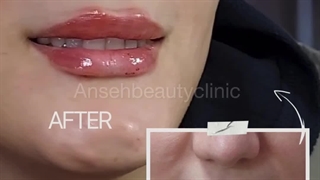 تزریق ژل لب در کلینیک زیبایی آنسه
