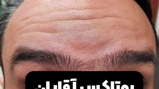 تزریق بوتاکس در کرج