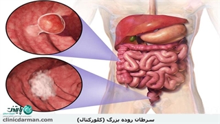 هشدار جدی❌ هرگز این علایم را نادیده نگیرید. نشانه‌های زودهنگام سرطان روده بزرگ