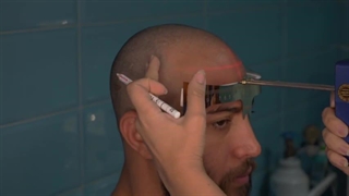 بهترین مرکز کاشت مو آقایان در مشهد + کاشت مو در مشهد اقساطی