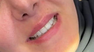 روکش سرامیکی دکتر طاهره شاکری