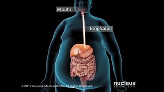 عمل معده جهت درمان چاقی