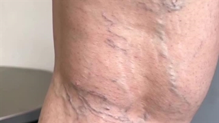 درمان واریس طنابی