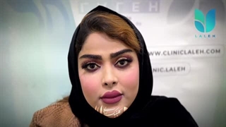 بعد از کاشت ابرو