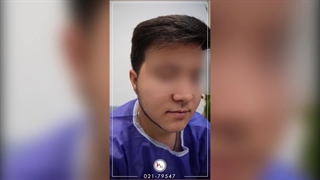 کاشت ریش با تراکم بالا و ظاهری کاملاً طبیعی