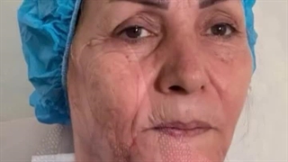 دکتر الهام کفایی متخصص تزریق چربی بلیچینگ دندان