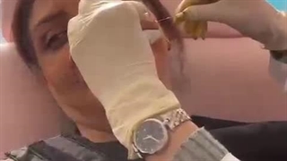 آموزش جایگذاری نخ لیفت صورت به صورت جامع