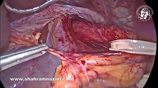 تکنیک تقسیم ماهیچه در میوتومی هلر برای جراحی آشالازی