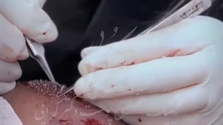 کلینیک کاشت مو دکتر کرایی برداشتن خال گوشتی