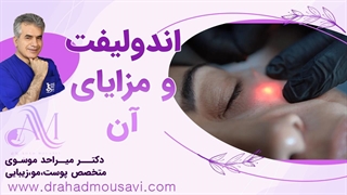 مزایای لیزر اندولیفت و کاربردهایش