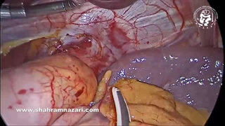 لاپاراسکوپی هلر میوتومی و دور فوندوپلیکیشن برای درمان آشالازی