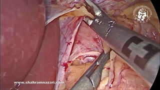 جراحی ریفلاکس (GERD): لاپاراسکوپی نیسن فوندوپلیکاسیون